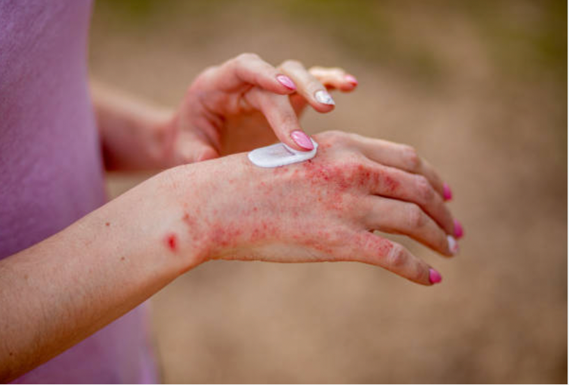 Psoriasis and Eczema: Understanding, Managing, and Supporting Skin Health Naturally