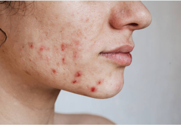 Natural Skincare, Vitamins, and Supplements to Reduce Pimples and Acne: Science-Backed Insights
