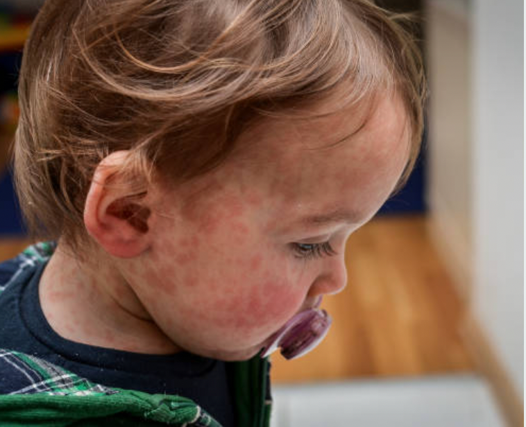 Managing and Supporting Recovery from Measles